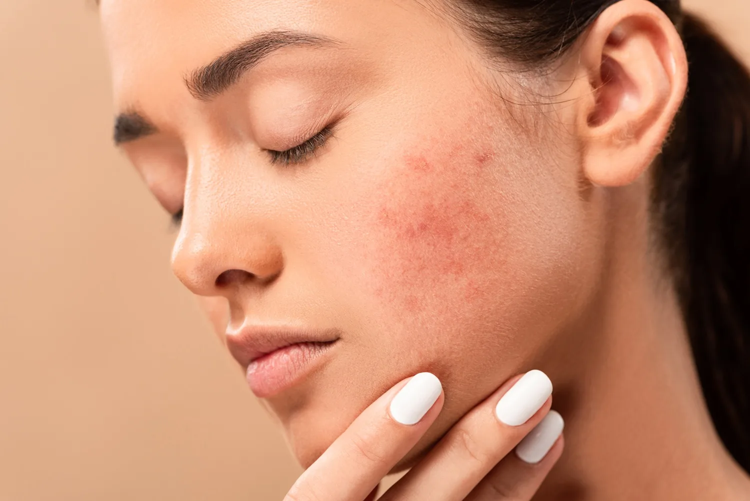 Acne Positivity Day: Η ακμή δεν επηρεάζει μόνο το δέρμα μας