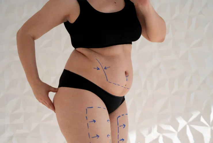 Λιποαναρρόφηση πριν το καλοκαίρι ή πώς ο πλαστικός χειρουργός μπορεί να σας αλλάξει τη ζωή