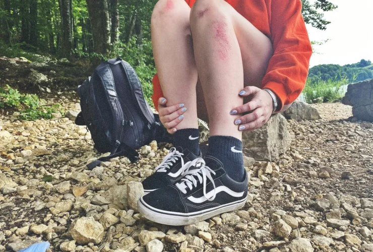 «Γιατί με τσιμπάνε πάντα τα κουνούπια;» – Μάθε τους λόγους που προτιμούν εσένα και όχι τους άλλους!