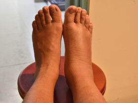 Θρόμβωση: Τα 7 «αθόρυβα» σημάδια που μοιάζουν με απλές ενοχλήσεις αλλά κρύβουν κίνδυνο