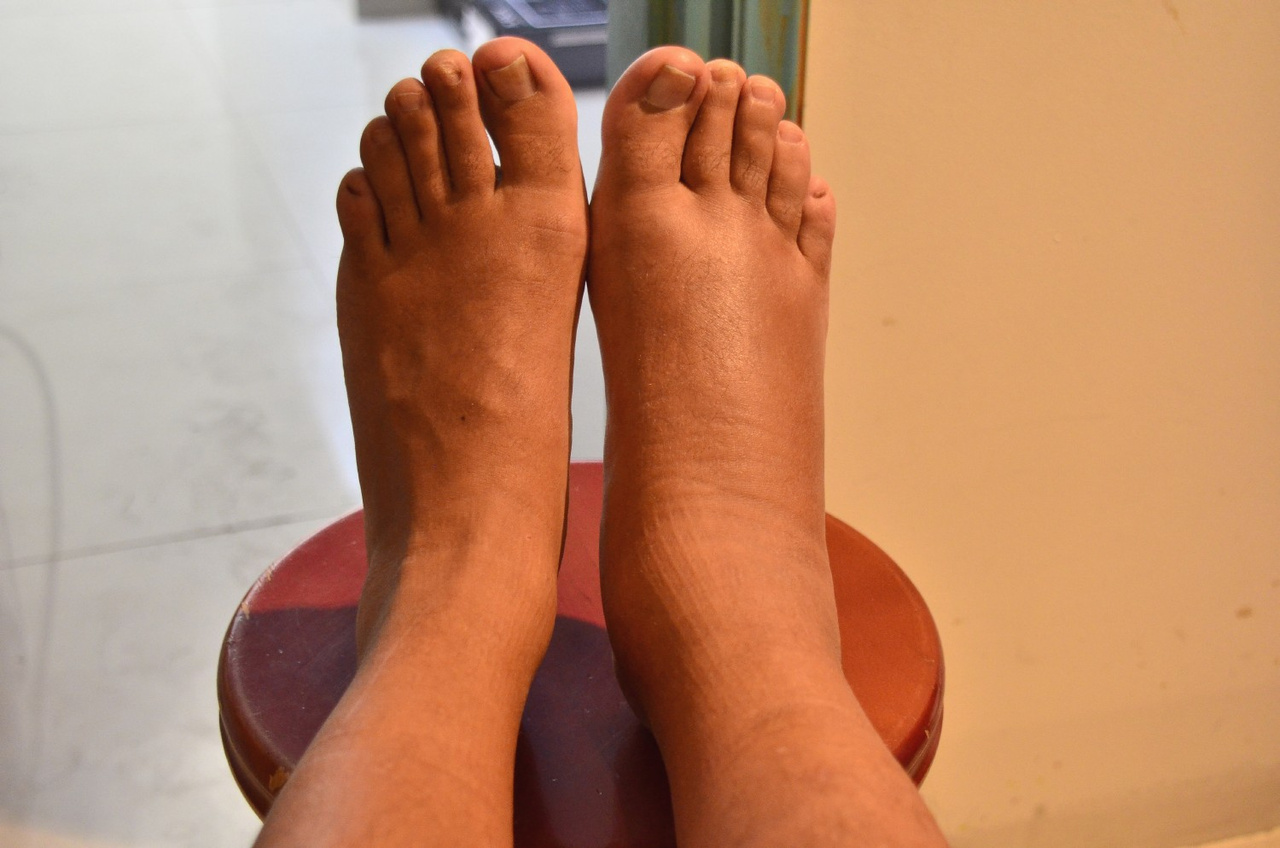 Θρόμβωση: Τα 7 «αθόρυβα» σημάδια που μοιάζουν με απλές ενοχλήσεις αλλά κρύβουν κίνδυνο