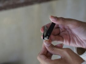 Μην τις τραβάτε ποτέ: Ο ασφαλής τρόπος να εξαφανίσετε τις παρανυχίδες χωρίς μόλυνση